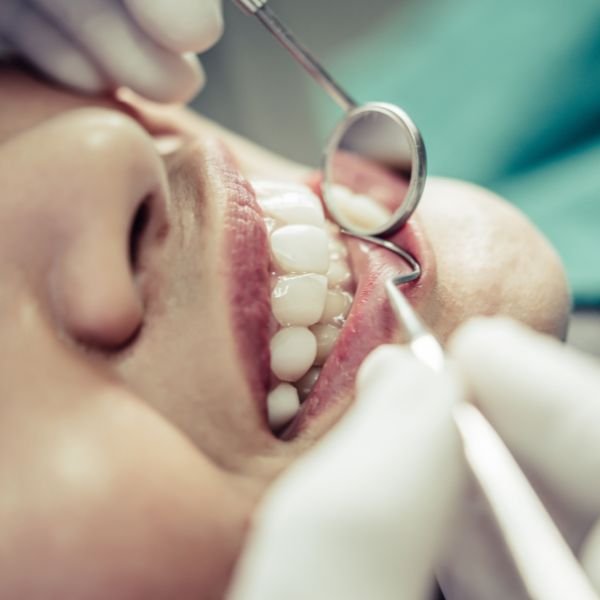 canal no dente