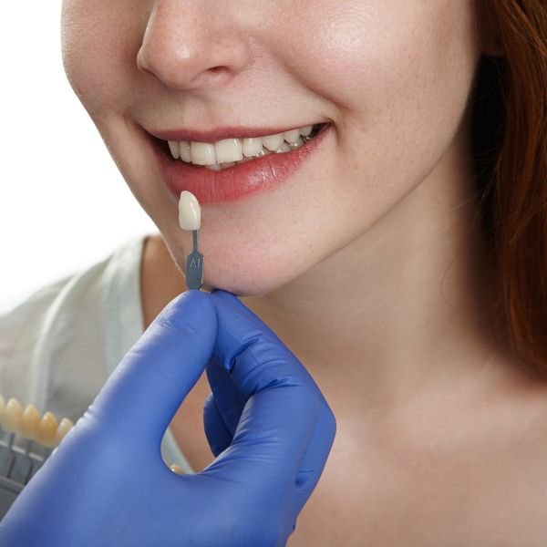 lente de contato dental em salvador